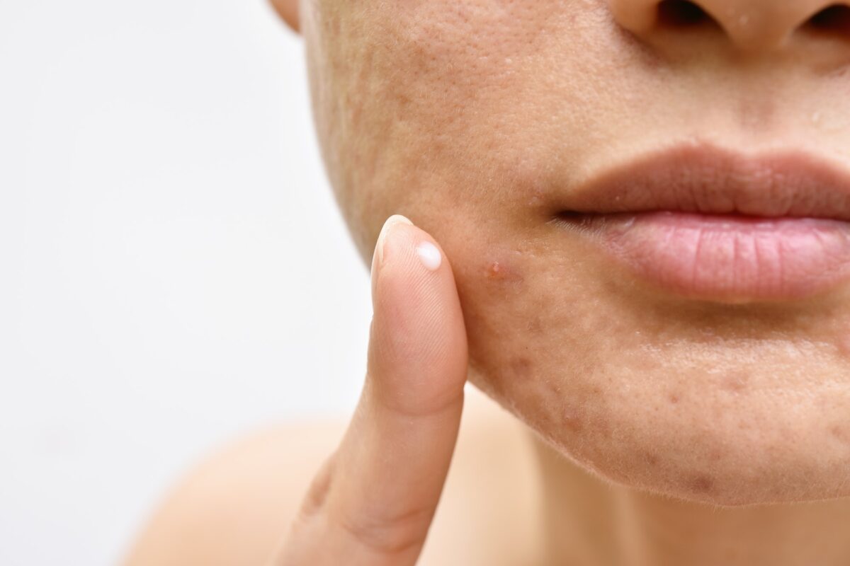 Lutter contre l'Acné : crème anti acné & solutions anti-boutons